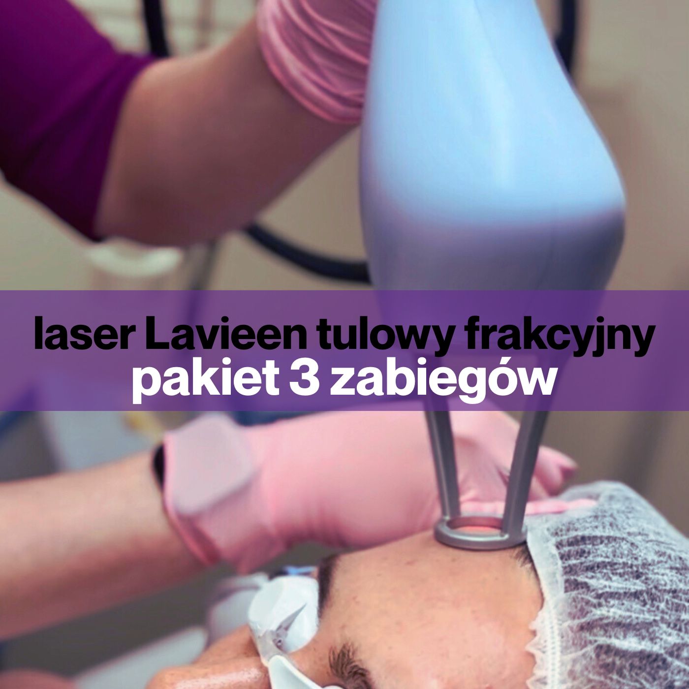 Pakiet 3 zabiegów - lasera tulowego, frakcyjnego Lavieen
